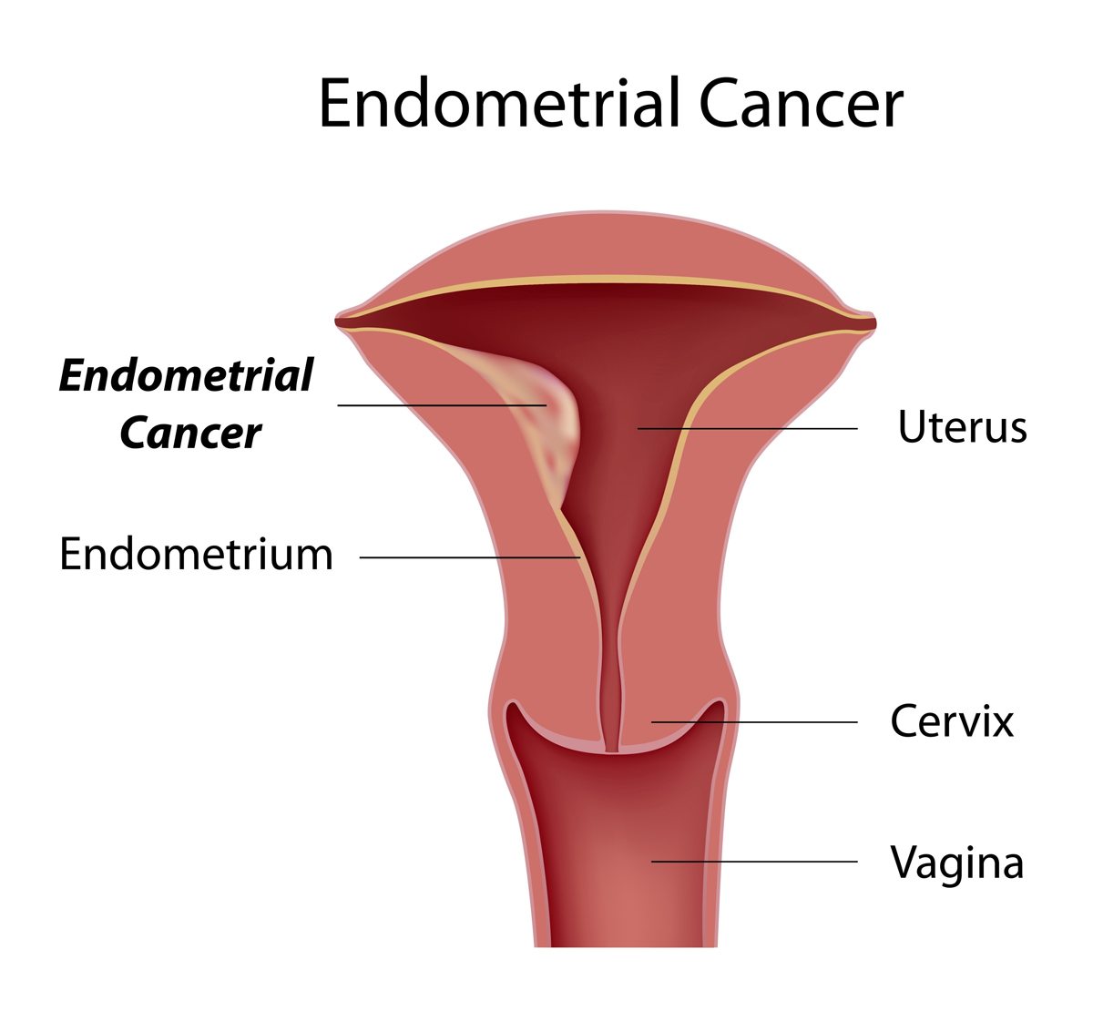 krebs_endometrium