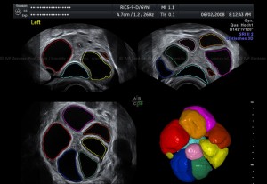 Follikel-Monitoring in 3D